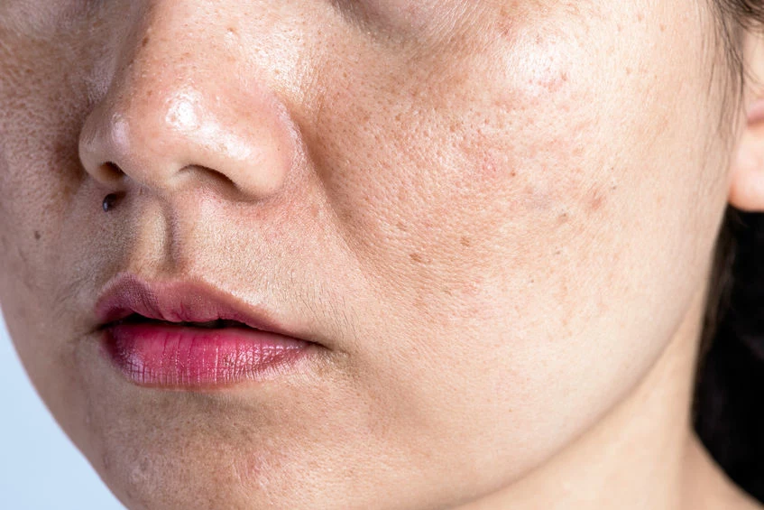 Poznaj sposoby na zmatowienie skóry twarzy
