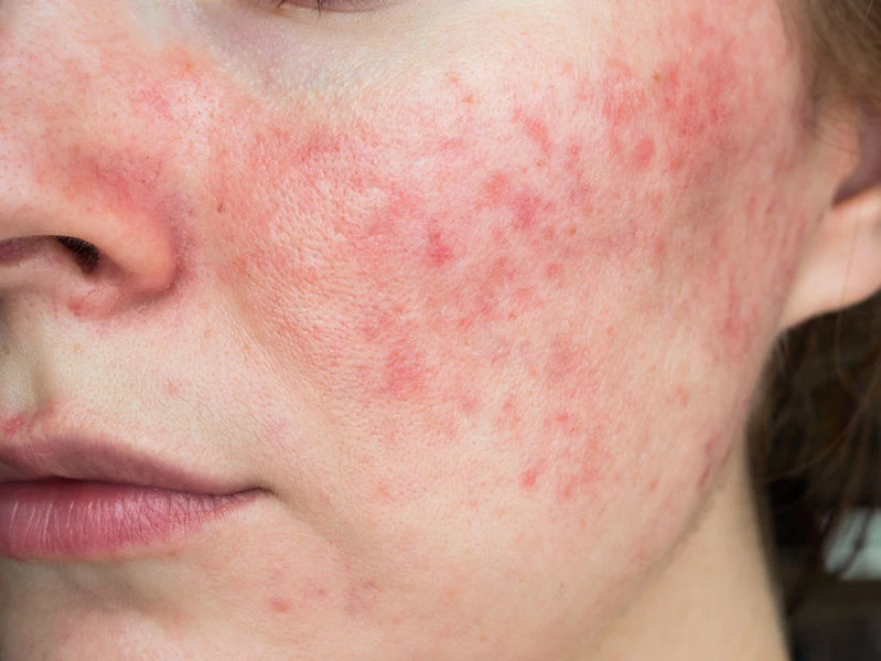 Nużyca może przypominać alergię lub trądzik