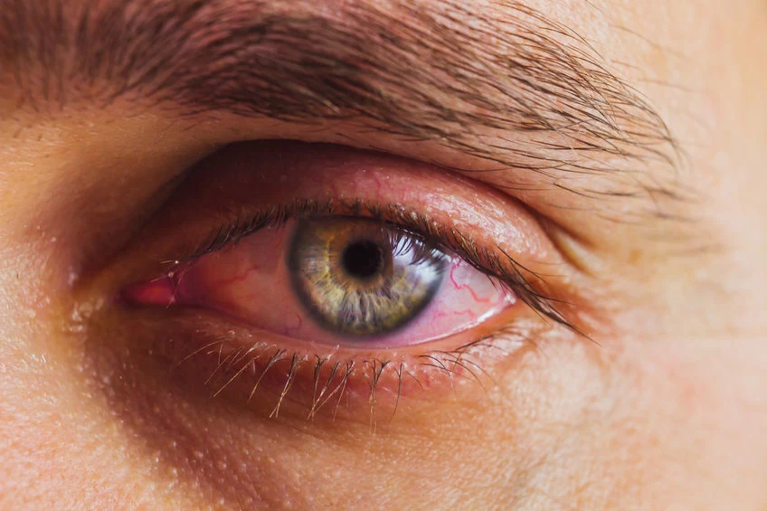 Nużeniec często atakuje oczy, a objawy łatwo pomylić z zapaleniem spojówek