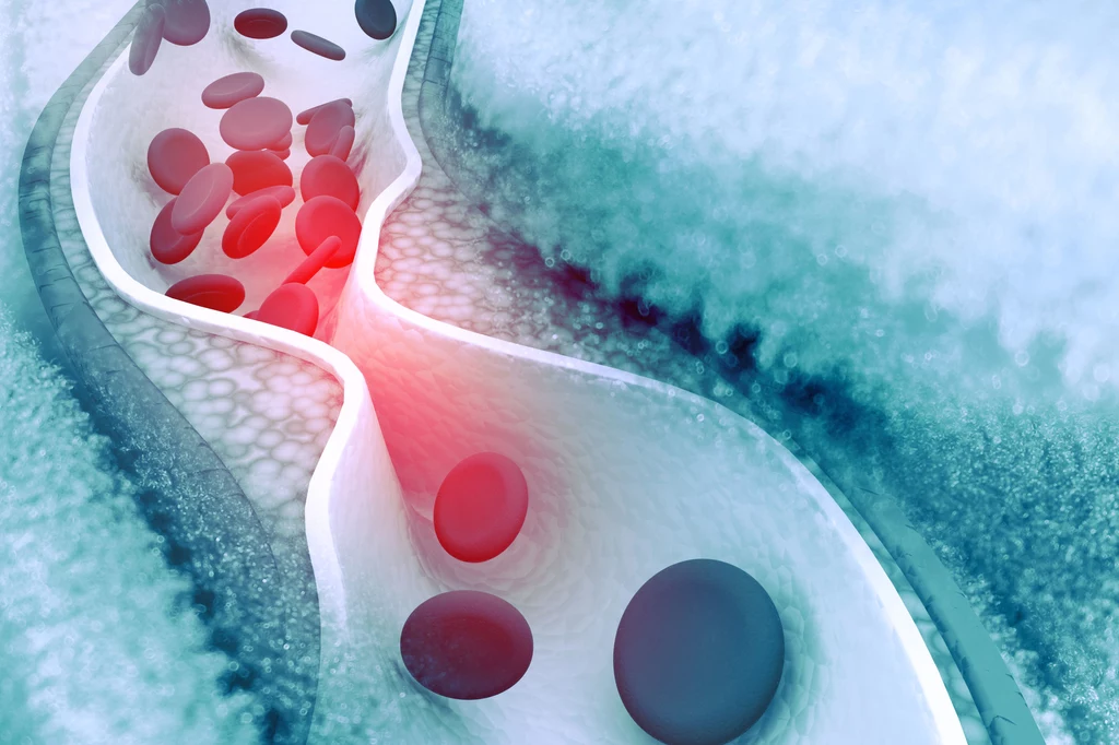 Nowy sposób na obniżenie poziomu cholesterolu we krwi