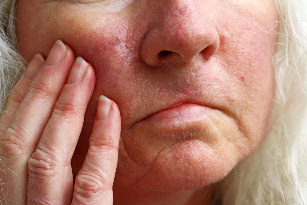 Maść kasztanowa może pomóc na zaczerwienioną skórę twarzy, ale nie tylko