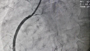 Koronografia pozwala ocenić stan żył i tętnic 