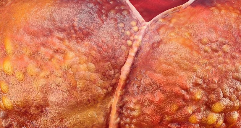 Biała wspiera system immunologiczny, o którym warto pomyśleć na progu wiosny. Pomaga niwelować bóle reumatyczne i zapobiegać chorobom zwyrodnieniowym. Obie: i biała, i czarna stymulują perystaltykę jelit i usprawniają metabolizm. Przyspieszają usuwanie złogów, zbędnych produktów przemiany materii i skutecznie znoszą zaparcia. Składniki czarnej rzepy są dużym wsparciem dla wątroby, mają działanie żółciopędne. Czarna jest warzywem z wyboru przy niedokrwistości. Naukowcy przypisują jej działanie tożsame z antybiotycznym. Wyciągi z czarnej rzepy są pomocne przy uporczywym kaszlu. Biała wspiera system immunologiczny, o którym warto pomyśleć na progu wiosny. Pomaga niwelować bóle reumatyczne i zapobiegać chorobom zwyrodnieniowym. Obie: i biała, i czarna stymulują perystaltykę jelit i usprawniają metabolizm. Przyspieszają usuwanie złogów, zbędnych produktów przemiany materii i skutecznie znoszą zaparcia. Składniki czarnej rzepy są dużym wsparciem dla wątroby, mają działanie żółciopędne. Czarna jest warzywem z wyboru przy niedokrwistości. Naukowcy przypisują jej działanie tożsame z antybiotycznym. Wyciągi z czarnej rzepy są pomocne przy uporczywym kaszlu.