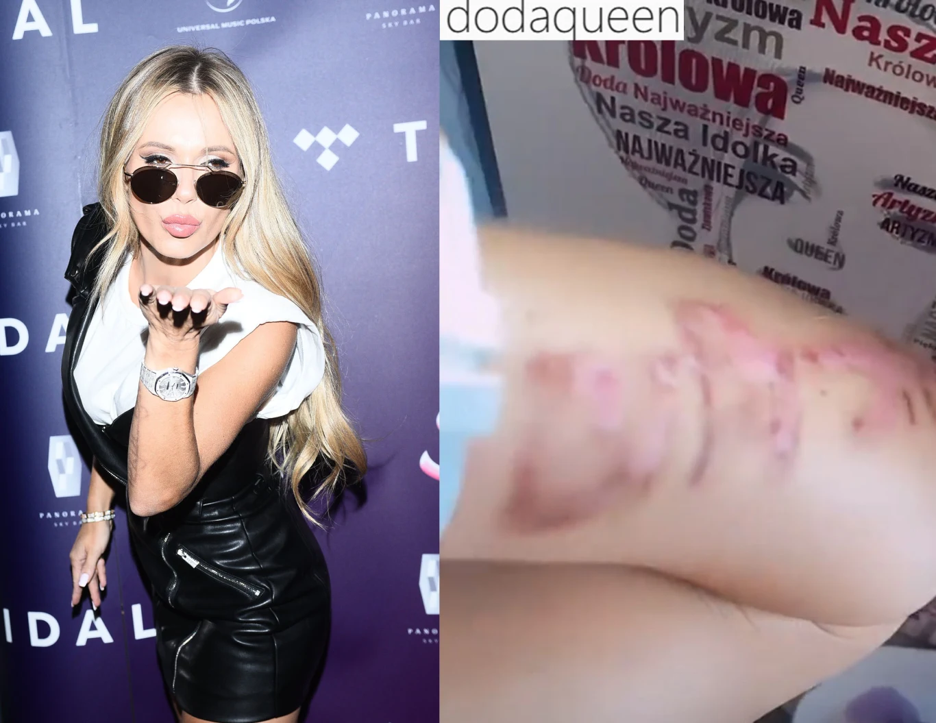 Doda pokazała proces usuwania tatuażu na swoim instastory 