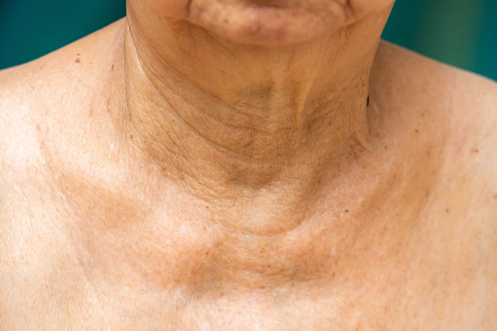Zmarszczki są nie tylko oznaką starzenia się skóry, ale mogą świadczyć o przeżywaniu długotrwałego stresu 