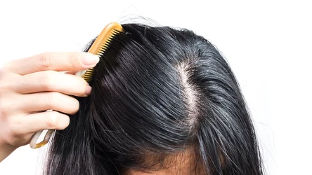 Przetłuszczające się włosy to częsty problem, który może dotyczyć każdego. 