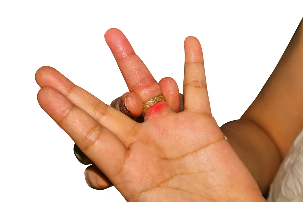 W zdjęciu pierścionka z opuchniętego palca pomoże mydło i folia