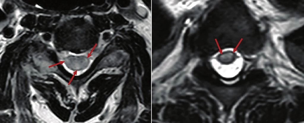 Na zdjęciach widać zapalenie rdzenia kręgowego /Fot. Frontiers in Immunology