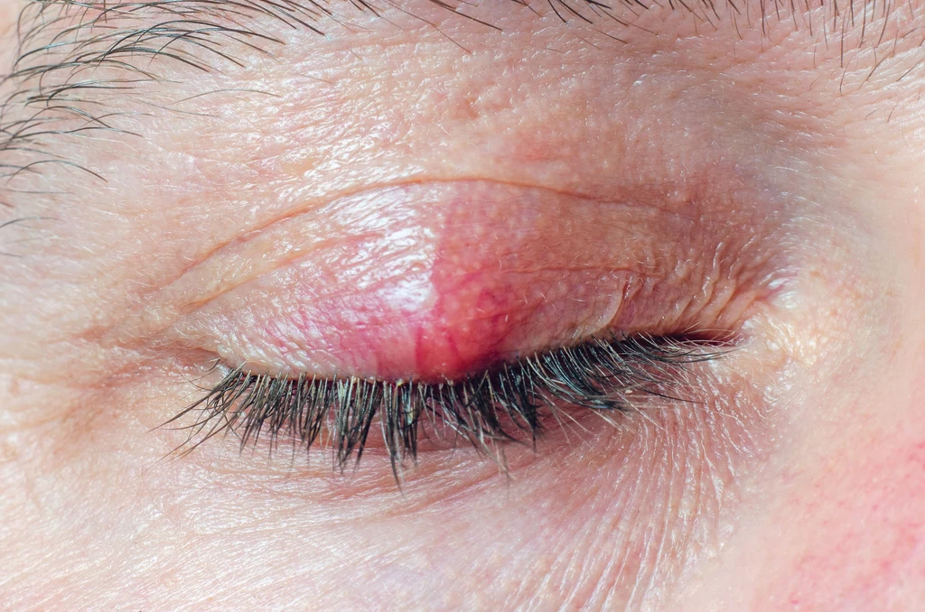 Okolica oczu jest bardzo podatna na infekcje bakteryjne