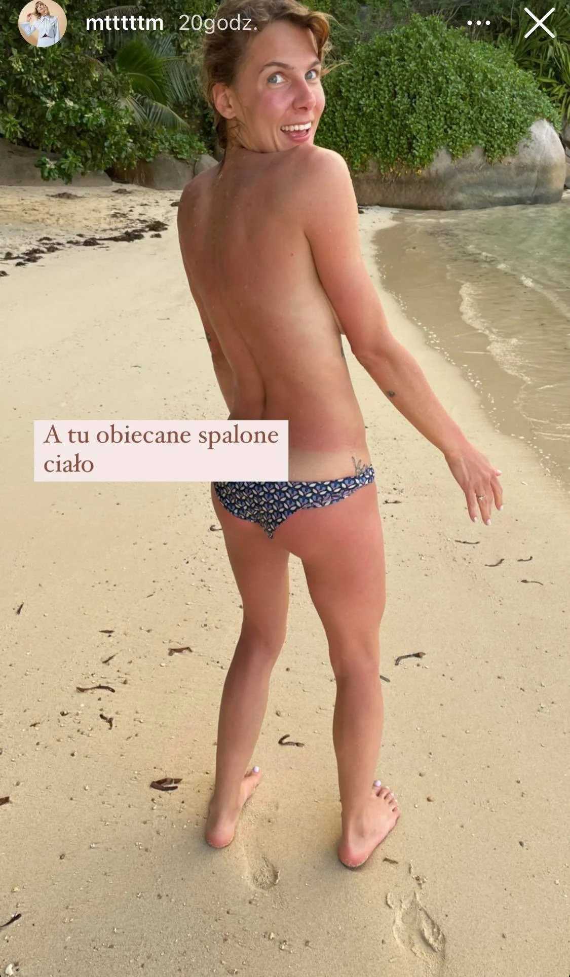 Marta Wierzbicka nabawiła się poparzenia słonecznego Marta Wierzbicka nabawiła się poparzenia słonecznego