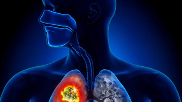 Rak płuc   

Rak płuc to jeden z najgorzej rokujących nowotworów. Szacuje się, że każdego roku na raka płuc umiera ponad 24 tys. Polaków. Niestety, choroba w początkowej fazie jest bardzo trudna do wykrycia. Z tego powodu większość pacjentów zgłasza się do lekarza w zaawansowanym stadium, które z kolei jest już praktycznie nie do wyleczenia. Trzeba pamiętać, że bezpośrednią przyczyną raka płuc jest palenie papierosów. Jak pokazują badania — odpowiada ono nawet za 90 proc. wszystkich przypadków choroby.   Wczesny rak płuc może nie dawać żadnych objawów. Występujące symptomy mogą być także bardzo mało charakterystyczne i wskazywać mogą na wiele różnych schorzeń. Chodzi m.in. o kaszel, duszności, świszczące oddech czy chrypka. Wraz z pogłębieniem choroby pojawić się mogą poważniejsze objawy — wydzielina z krwią, znaczna utrata wagi, ból w klatce piersiowej, nawracające się zapalenie płuc, problemy z przełykaniem. W przypadku wystąpienia przerzutów, np. do mózgu, wątroby i innych organów, pojawić się mogą miejscowe bóle i żółtaczka.