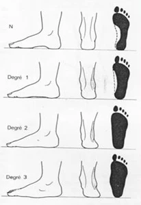 Płaskostopie - jak prezentuje się stopa?