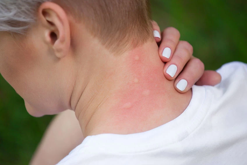 Po ukąszeniu komara na skórze pojawia się bąbel oraz obrzęk, któremu towarzyszy ból i swędzenie