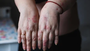 Objawy łuszczycy są dość charakterystyczne