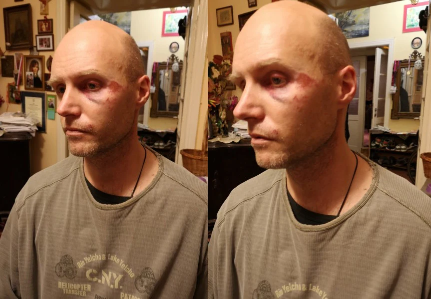 Syn Krzysztofa Krawczyka z ranami na twarzy Syn Krzysztofa Krawczyka z ranami na twarzy