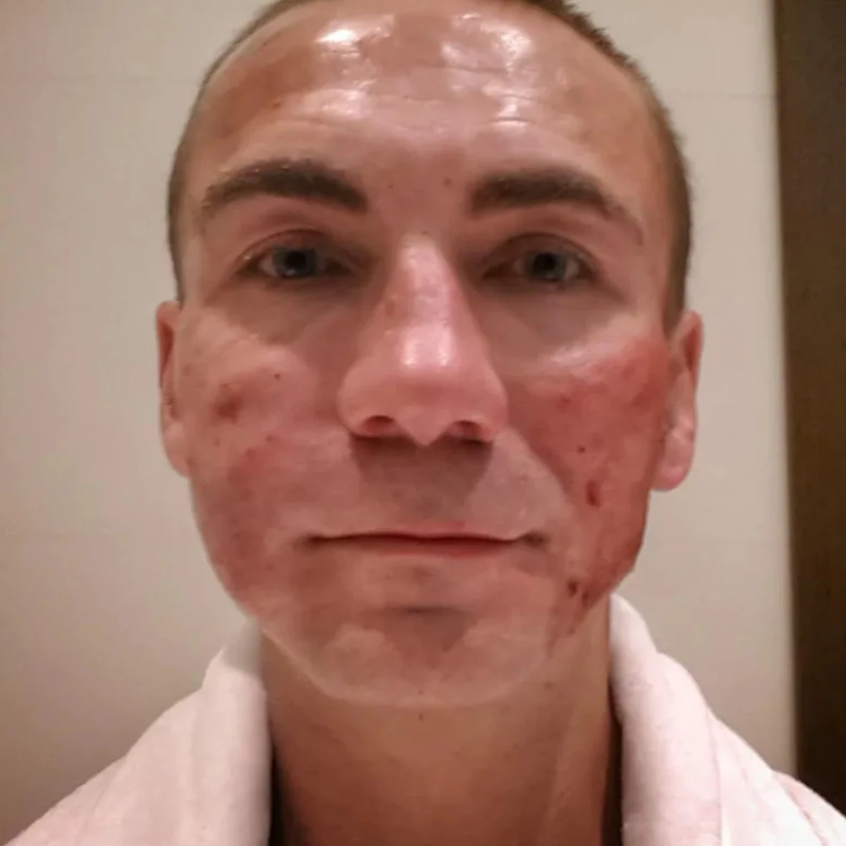 Przemek Kossakowski po "wampirzym liftingu", fot. https://www.instagram.com/newonce_bar/ Przemek Kossakowski po "wampirzym liftingu", fot. https://www.instagram.com/newonce_bar/