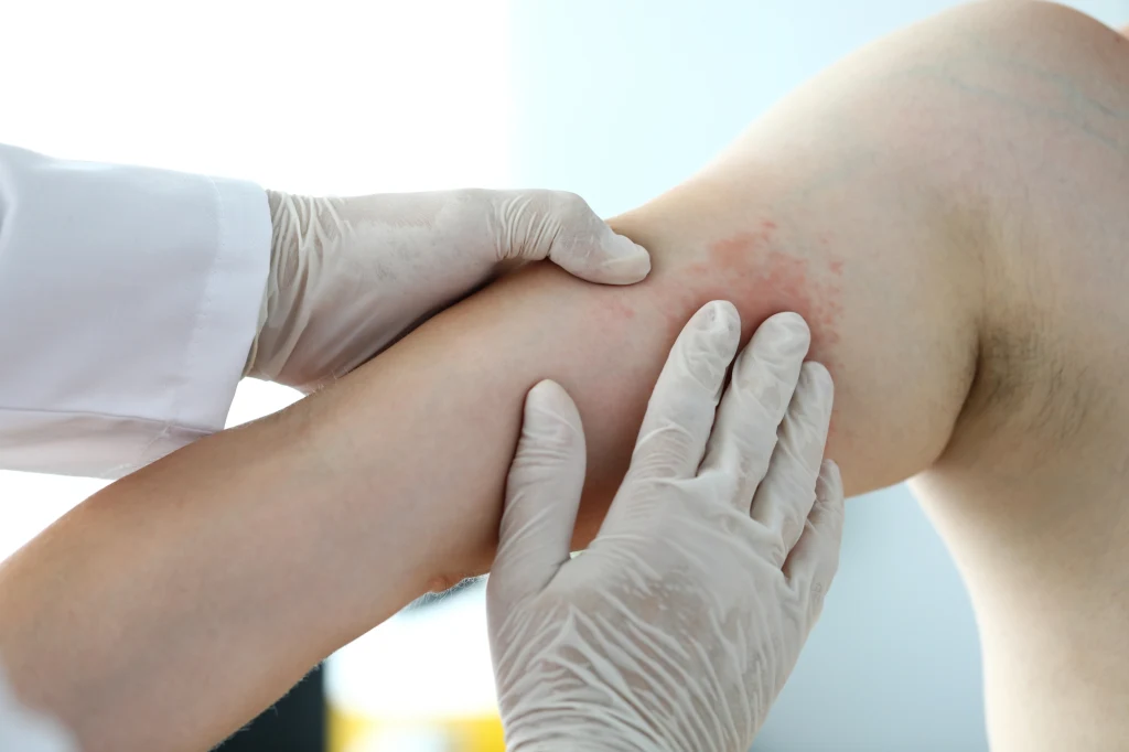 Ospę wietrzną, jak i półpasiec wywołuje ten sam wirus Ospę wietrzną, jak i półpasiec wywołuje ten sam wirus