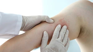 Ospę wietrzną, jak i półpasiec wywołuje ten sam wirus