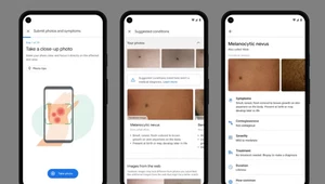 ​Nietypowy pieprzyk lub wysypka na skórze - Google sprawdzi, czy to coś poważnego