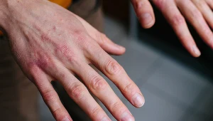 Możliwych powikłań po COVID-19 jest znacznie więcej, niż sądzono 