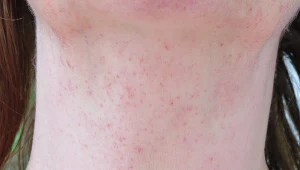 Na zdj. wysypka spowodowana intensywnymi wymiotami