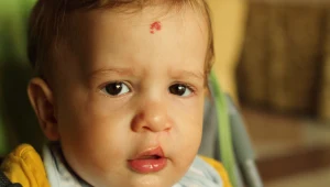 To nie tylko problem estetyczny, zajęcza warga utrudnia naukę mowy, a nawet przyjmowanie pokarmówd