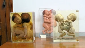 Bliźnięta syjamskie błędnie nazywa się "zrośniętymi"; one się nie zrosły, a nie rozdzieliły