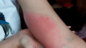 Ukąszenia owadów mogą być śmiertelne; sprawdź, jak prawidłowo usunąć żądło (na zdj. obrzęk po ugryzieniu osy)