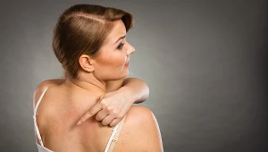 AZS to inaczej przewlekła dermatoza zapalna – choroba skóry, której towarzyszy świąd oraz liszajowacenie