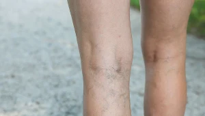 Zakrzepica często atakuje młode kobiety stosujące antykoncepcję doustną