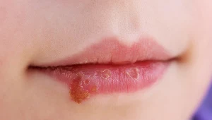 U niemowląt i dzieci w przypadku kandydozy kącików ust pojawiają się charakterystyczne zajady