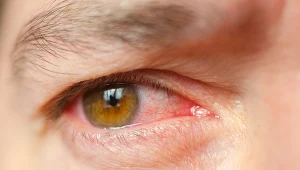 Z przekrwionymi oczami udaj się do okulisty