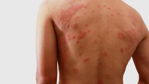 Leczenie ziarniniaka obrączkowatego polega na stosowaniu miejscowych opatrunków z kortykosteroidam