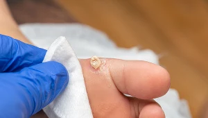 Kurzajek najlepiej pozbyć się w gabinecie dermokosmetycznym lub u dermatologa. Specjaliści mogą zastosować kurację laserem CO2 oraz krioterapię