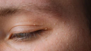 Prosaki można usunąć w gabinecie kosmetycznym Czytaj