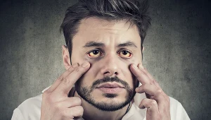 Żółtawe zabarwienie białek oczu zawsze powinno być sygnałem alarmowym