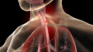 Ilustracja 3D przedstawiająca nowotwór w ludzkim przełyku