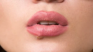 Opryszczka wargowa to uciążliwa choroba wywoływana przez wirusa