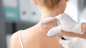 Na czerniaka można zachorować w każdym wieku; apelujemy - uważnie przyglądaj się swojej skórze, a przede wszystkim uważaj ze słońcem