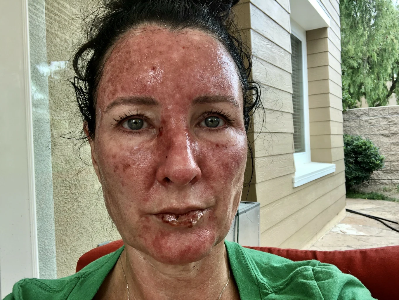 Kobieta stosuje leczenie specjalnym kremem. Dzięki temu uniknęła operacji, za to na jej twarzy pojawiło się duże zaczerwienienie Kobieta stosuje leczenie specjalnym kremem. Dzięki temu uniknęła operacji, za to na jej twarzy pojawiło się duże zaczerwienienie