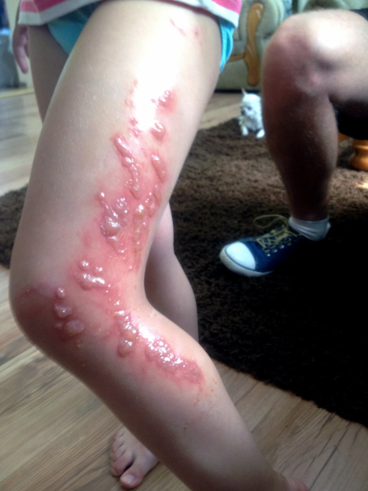 Pęcherze nie pojawiają się od razu. Chorobowo zmieniona skóra sprawia dotkliwy ból