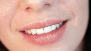 Twoje usta są suche i popękane? Sprawdź, co może być przyczyną