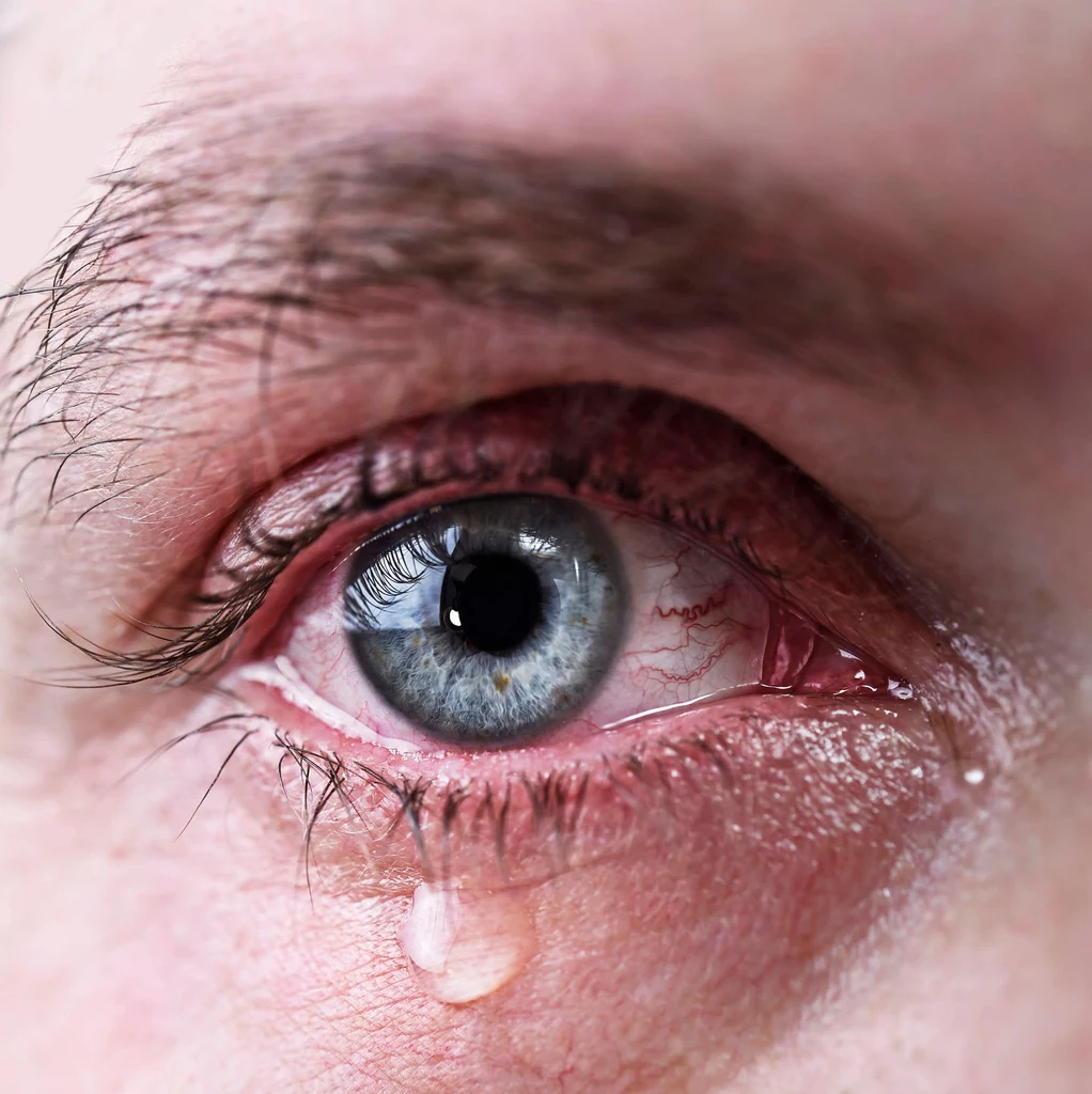 Metody na łzawiące oczy powinny być dostosowane do przyczyn problemu