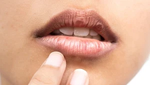 Słona woda, wiatr, odwodnienie - to wszystko powoduje, ze nasze usta nadmiernie wysychają