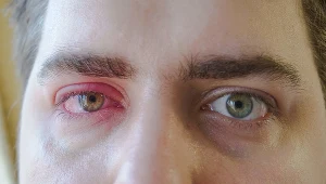 Zapalenie spojówki można łatwo przenieść z jednego oka na drugie. Nie drap i nie dotykach chorego oka