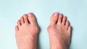 Postępujące haluksy mogą mieć poważne konsekwencje. Powodować mogą m.in. ból oraz problemy z poruszaniem się