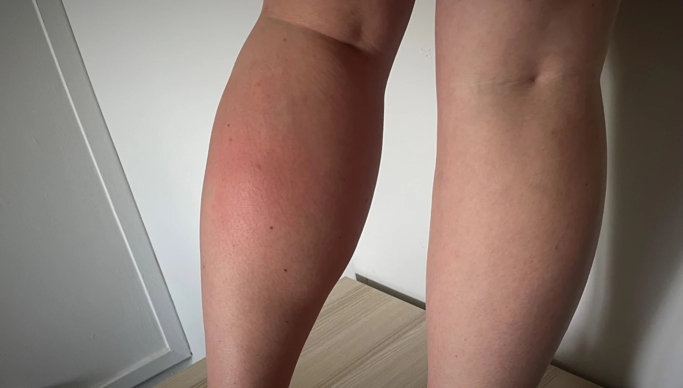 Ugryzienie przez bąka bydlęcego, zwanego też muchą końską, goi się długo i jest bardzo bolesne