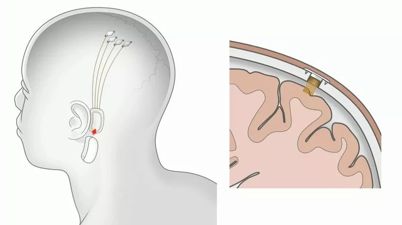 Implant przygotowany przez Neuralink