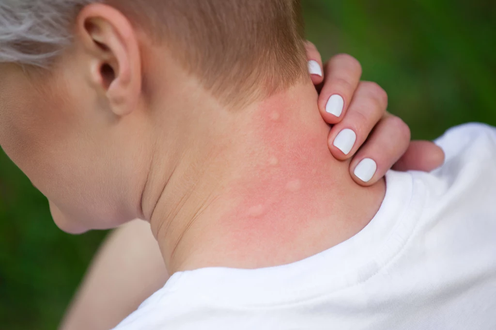 Skąd biorą się bąble po ukąszeniu komara? To ślina komara powoduje częste reakcje alergiczne, swędzenie i bąble 