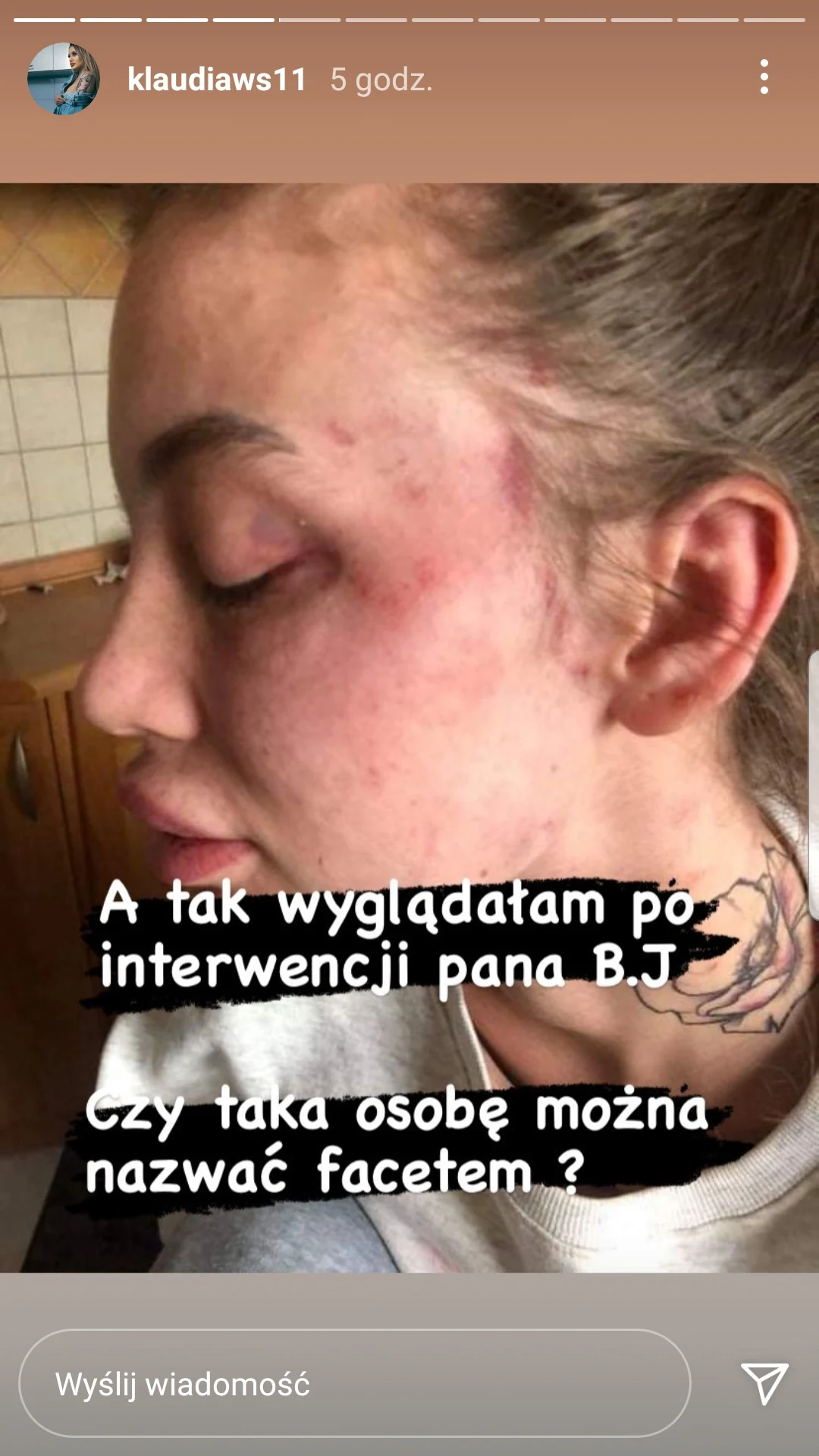 Klaudia podzieliła się wstrząsającymi zdjęciami /https://www.instagram.com/klaudiaws11 Klaudia podzieliła się wstrząsającymi zdjęciami /https://www.instagram.com/klaudiaws11